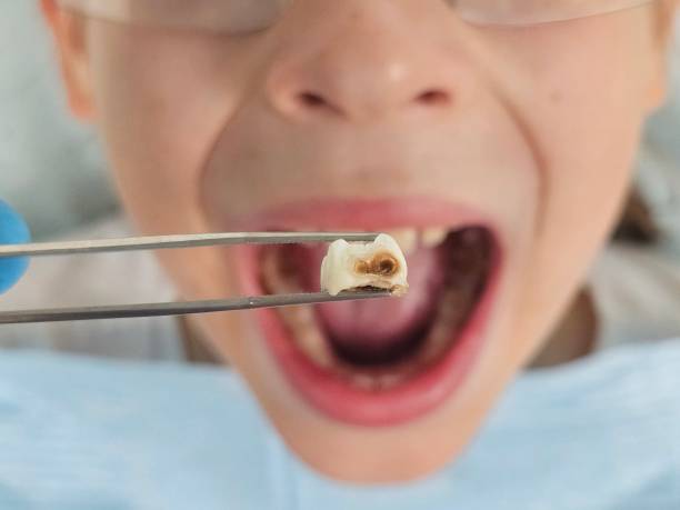 Best Knocked-Out Tooth (Avulsed Tooth) Treatment in Winnebago, MN